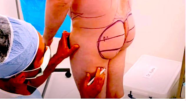 Male Buttock Implant Alternative with BBL